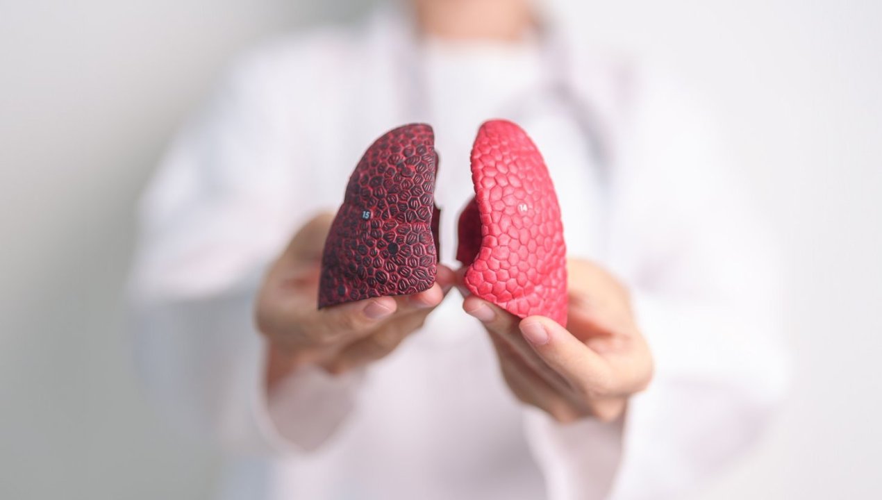 /numero-de-fallecidos-por-cancer-de-pulmon-aumento-13-en-la-region-de-arica